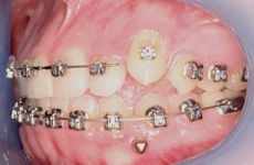 ortodontik mini vida yerletirilmesi