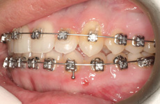 ortodontik mini vida kartlmas