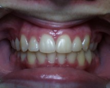 Crooked Teeth correction