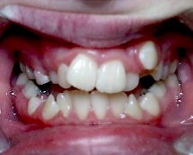 Crooked Teeth treatment