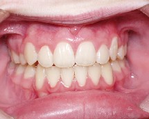 Crooked Teeth patient photo
