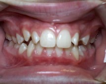 Crooked Teeth patient photo
