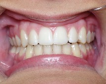 Crooked Teeth Sandy correction