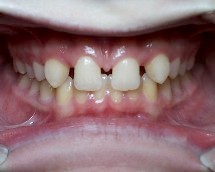 Missing Teeth Restored With Implants 
