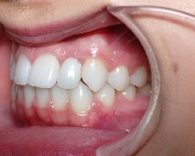 Missing Teeth correction in Utah