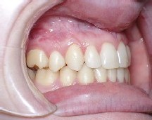 Underbite carter orthodontics